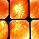 Birdshot Retinochoroidopathy